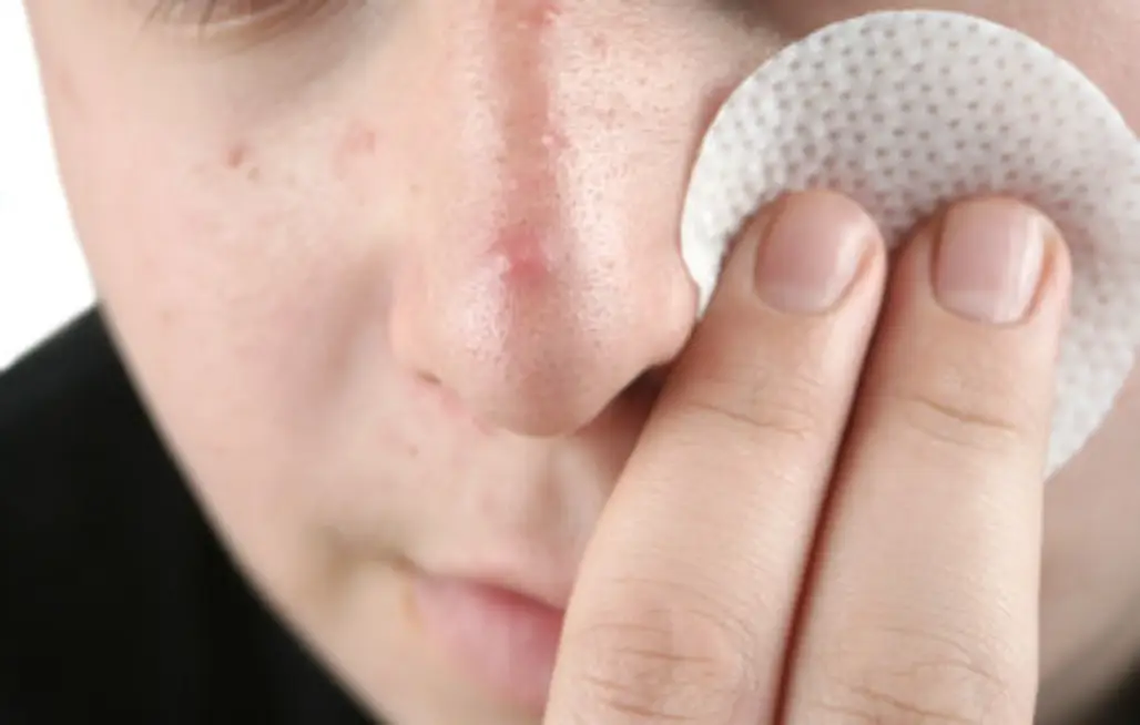 Are You Dealing with Acne?