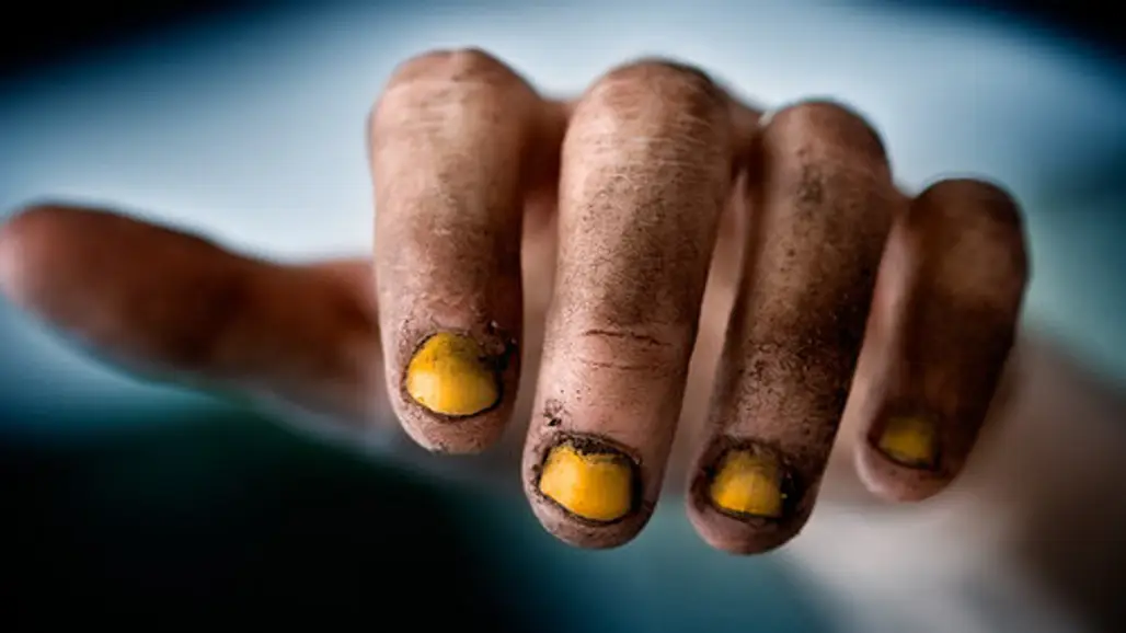 It Causes Your Nails to Turn Yellow