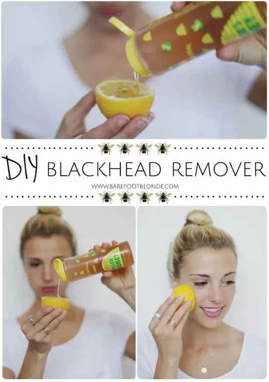 The Blackhead Remover You Need