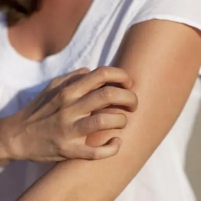 7 Ways to Get Rid of That Never-Ending Mosquito Itch ...